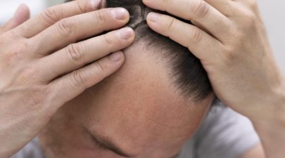 hair loss treatment for men