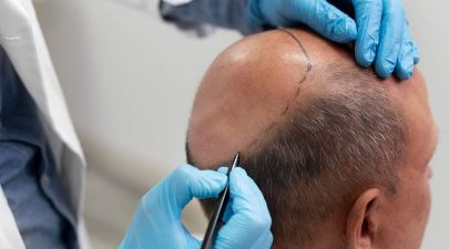 fue hair transplant malaysia