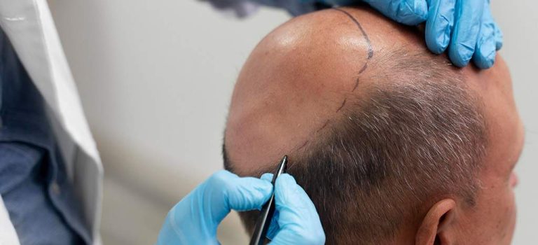 fue hair transplant malaysia