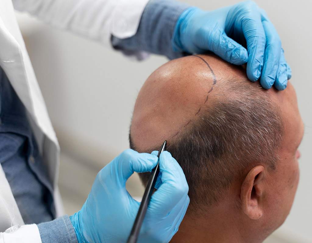 fue hair transplant malaysia
