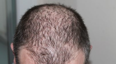 rawatan rambut gugur lelaki