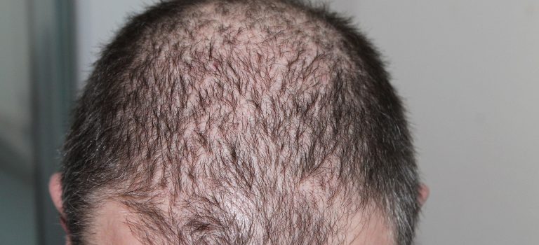rawatan rambut gugur lelaki