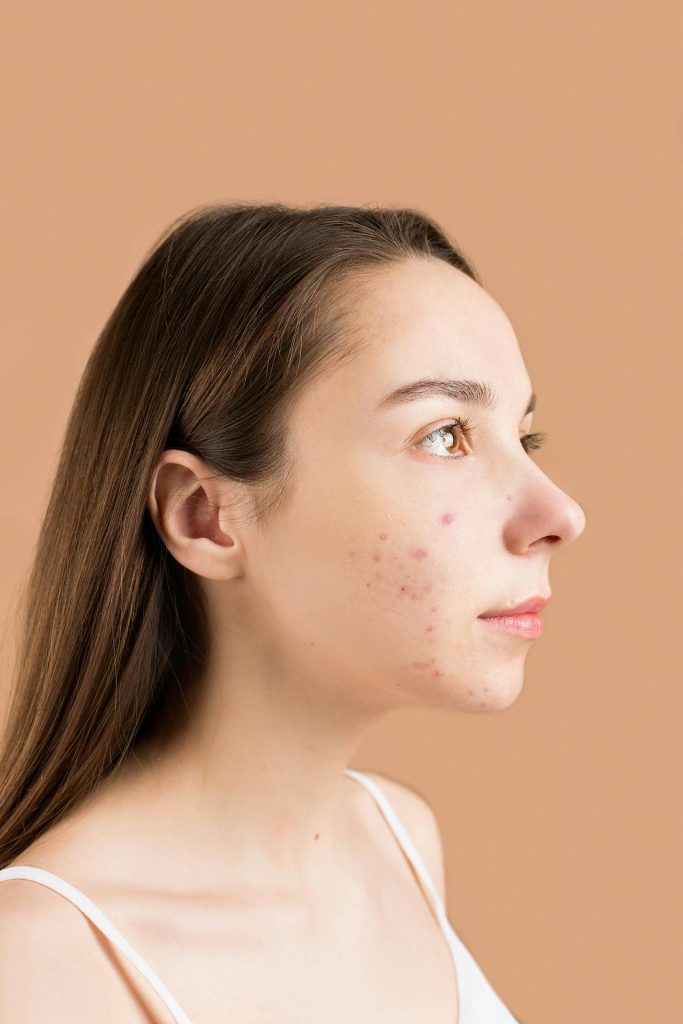 serum for acne