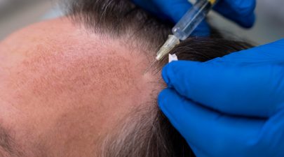 stem cell hair transplant