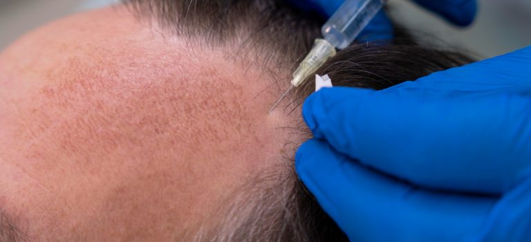 stem cell hair transplant