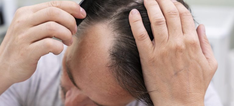 hair loss kl